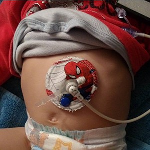bouton de gastrostomie bebe